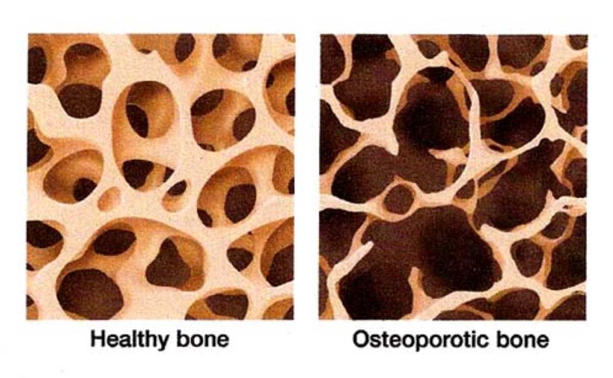 7 bone health